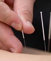 acupuncture1ss
